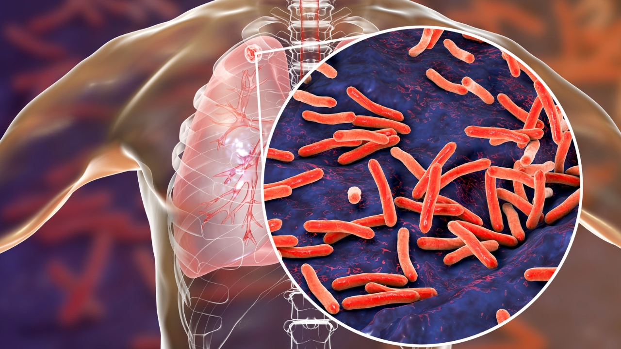 O áudio que circula nas redes sociais, alerta para uma nova variante de tuberculose O áudio que circula nas redes sociais, alerta para uma nova variante de tuberculose