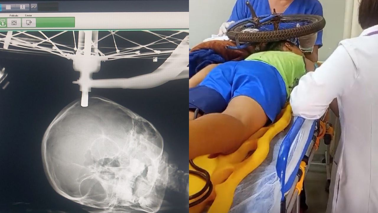 Criança fica com roda presa na cabeça em Uberaba