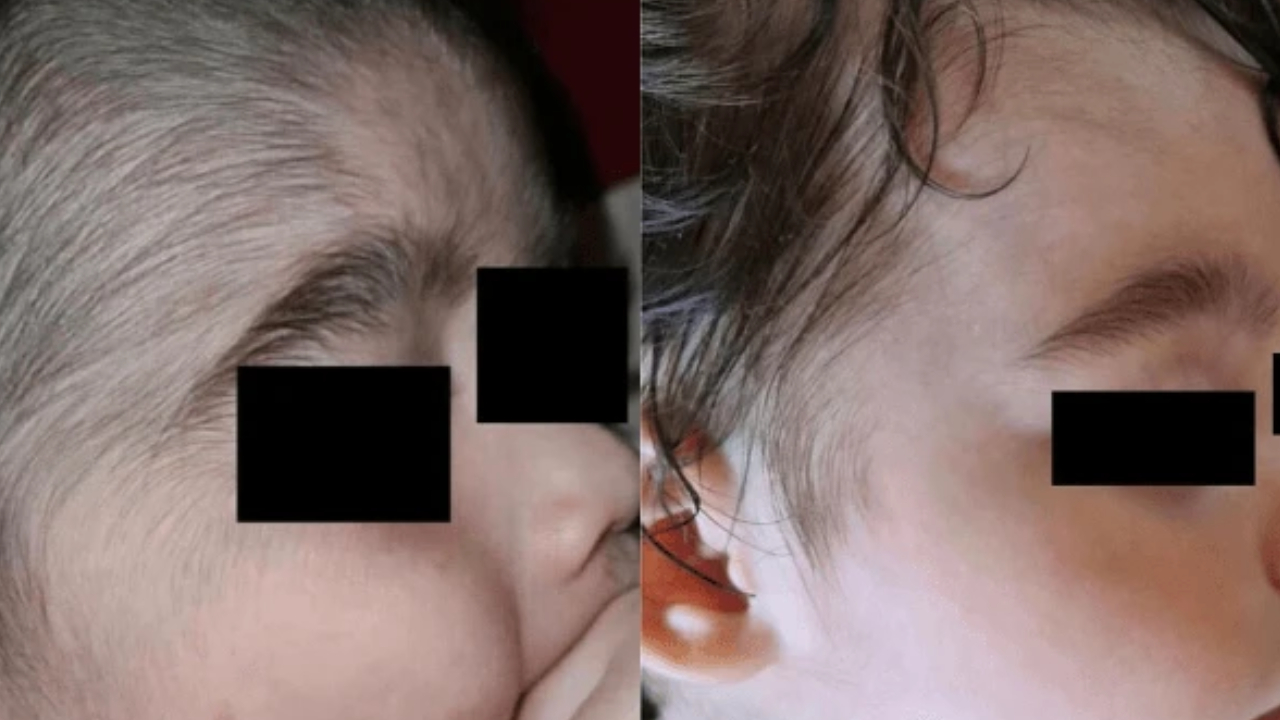 sindrome-do-lobisomem Síndrome do Lobisomem