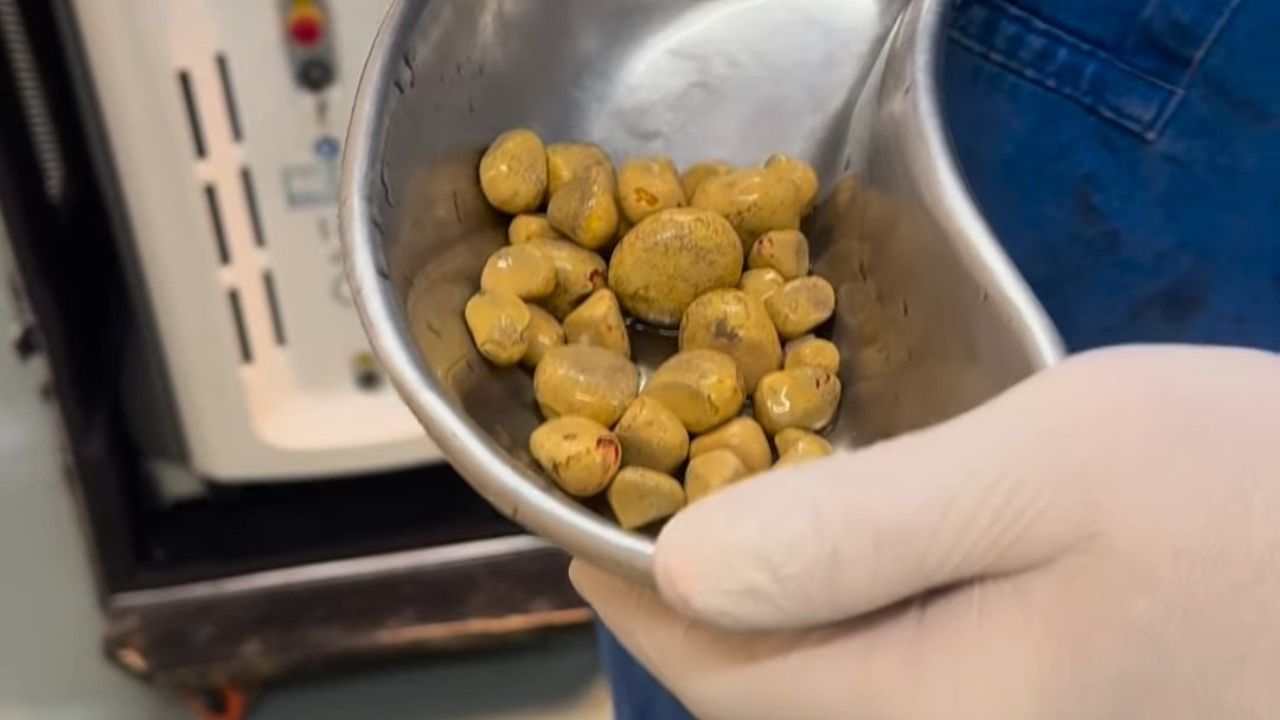 Médico de Ituiutaba detalha cirurgia rara após encontrar 35 cálculos na bexiga de paciente Médico de Ituiutaba detalha cirurgia rara após encontrar 35 cálculos na bexiga de paciente