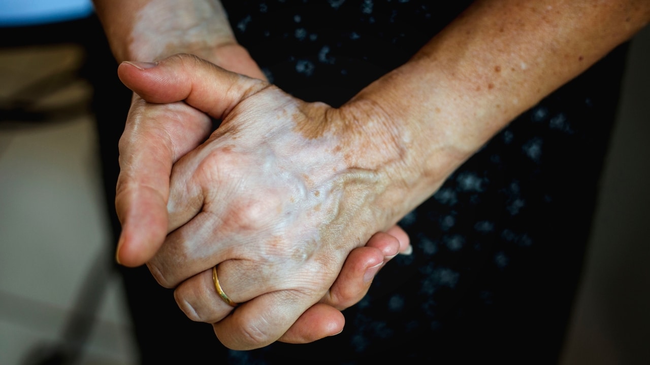 pessoa com vitilico para representar o Dia Mundial do Vitiligo