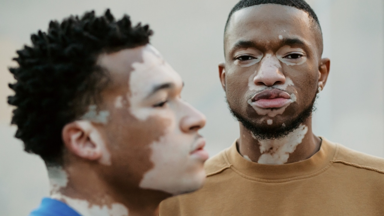 pessoa com vitilico para representar o Dia Mundial do Vitiligo