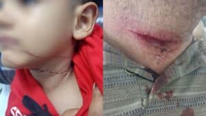 Menino de 5 anos e motociclista ficam feridos com linha de cerol em Uberlândia