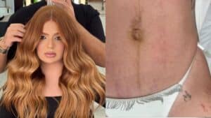 Viih Tube fez tratamento para estrias