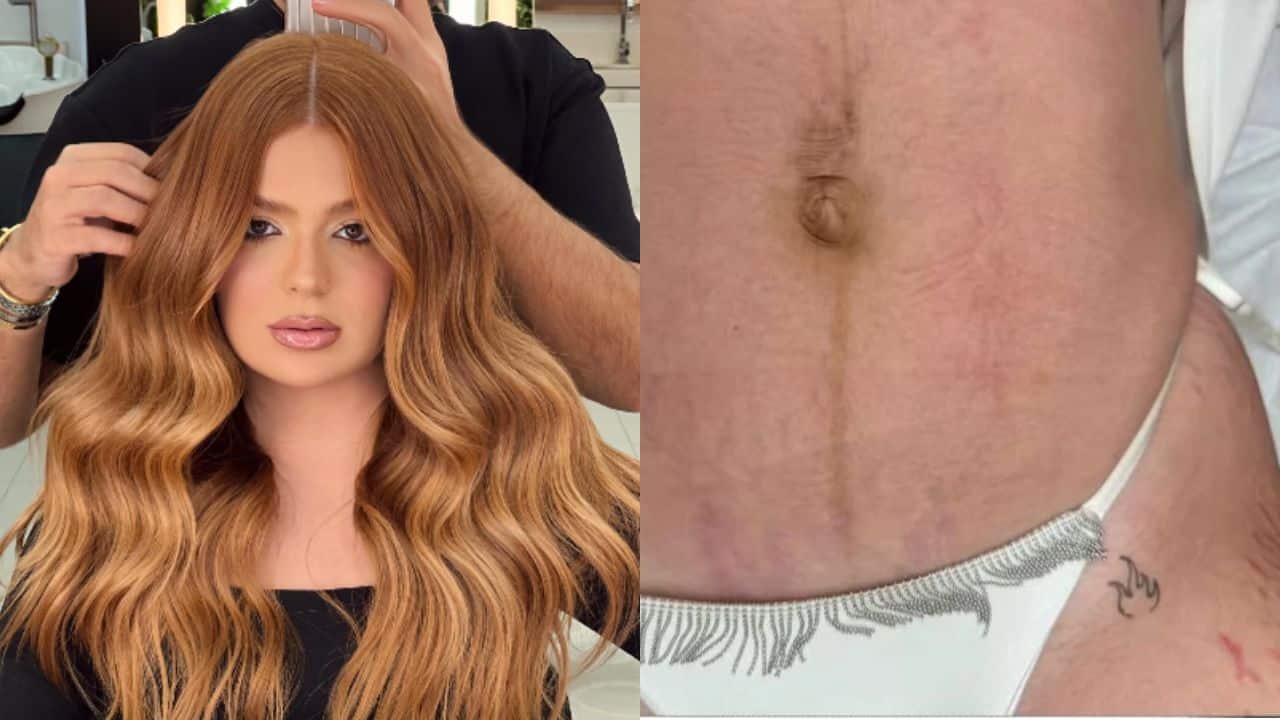 Viih Tube fez tratamento para estrias