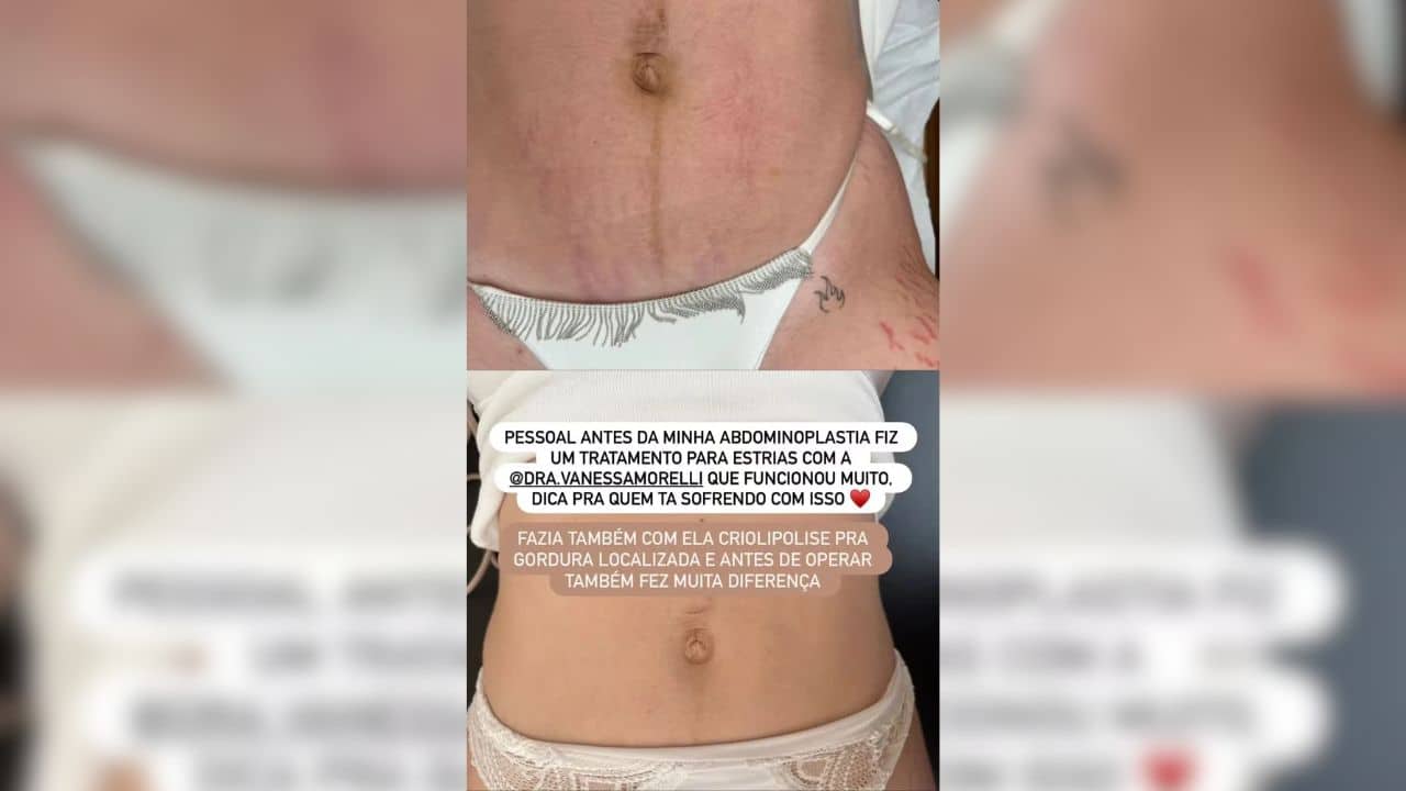 Viih Tube mostra antes e depois de tratamento para estrias