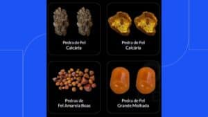 Diferentes tipos de pedra de fel