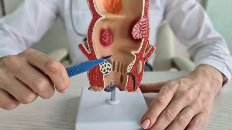 hemorroidas hemorroidas